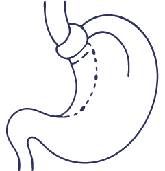 جراحة الارتجاع المعدي المريئي